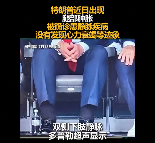 点点策略网 特朗普小腿肿胀确诊血管疾病，70岁以上人群需警惕